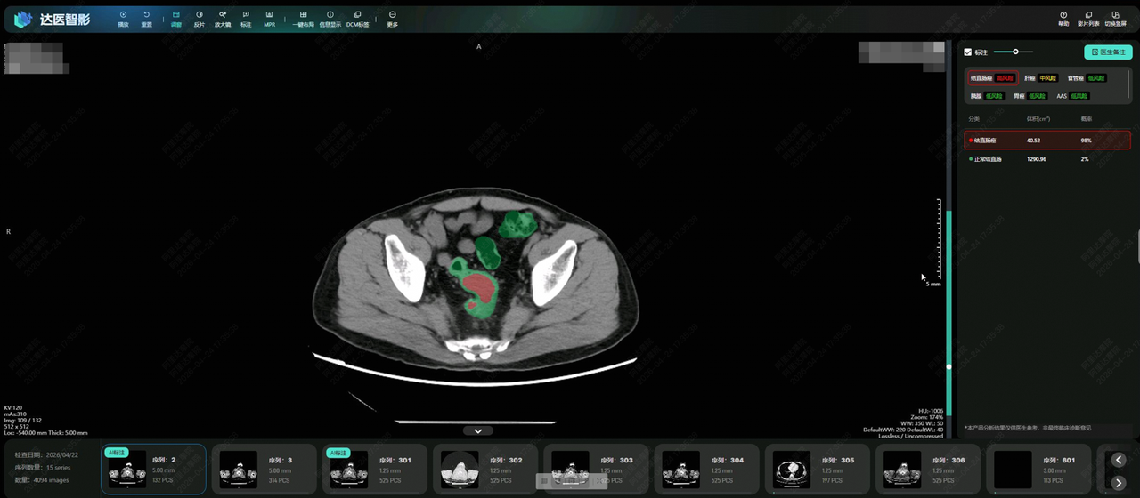 阿里达摩院 AI 全球首次实现肠癌“无感”检测，登上国际肿瘤学顶刊